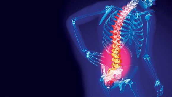 Osteoporosis Osteoporosis
